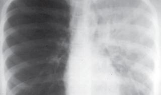 白肺的早期症状有哪些